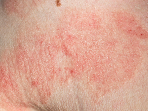 Eczema on skin