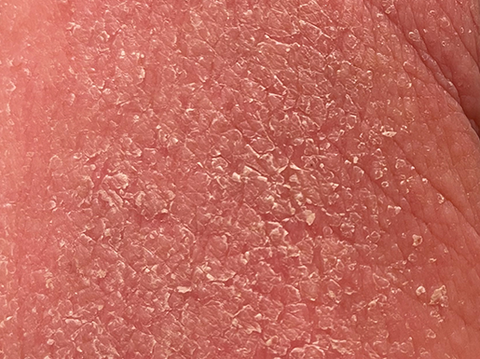 Topical steroid Withdrawal skin