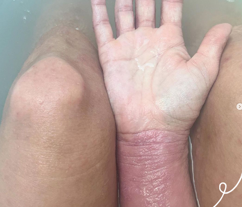 Women in the bath showing wrist with topical steroid withdrawal and eczema