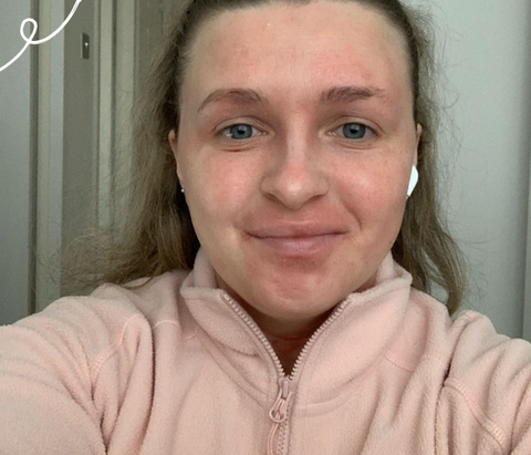 women smiling with eczema on her face