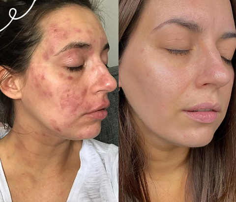 Women with Eczema on her face 