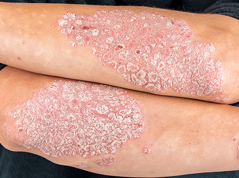 Psoriasis myths, busted!