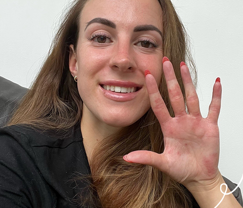 Women holding her hand up to the camera with eczema on the hand