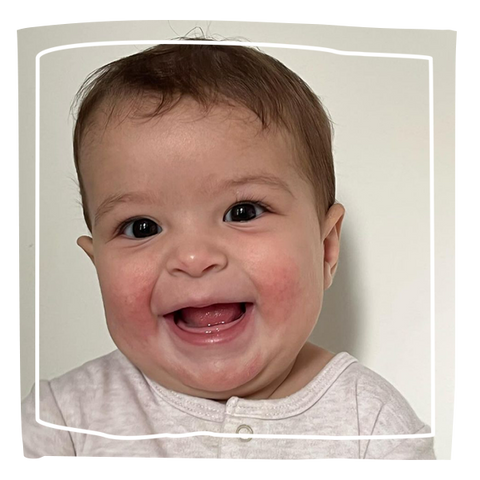 Baby smiling with eczema on face 