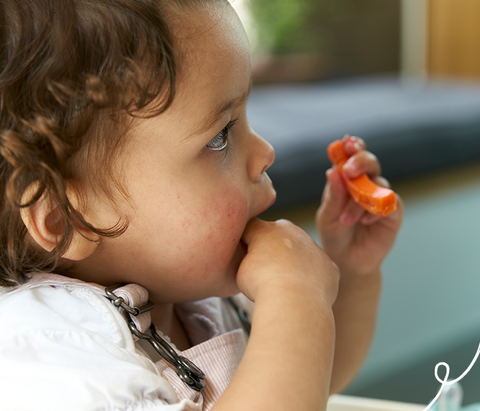 Young Girl eating carrot stick with eczema on face 