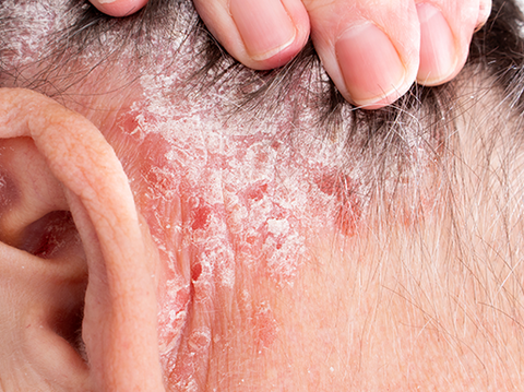Psoriasis behind someone ear and on a scalp