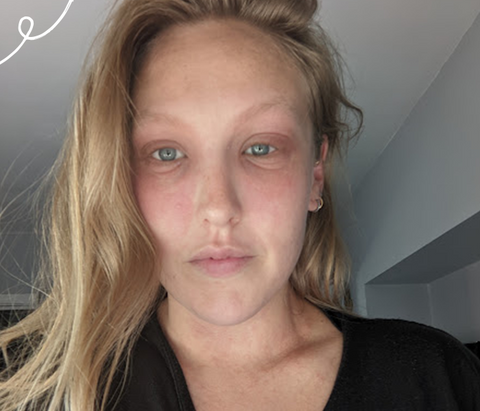 Women with eczema around eyes