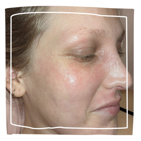 women's face with eczema