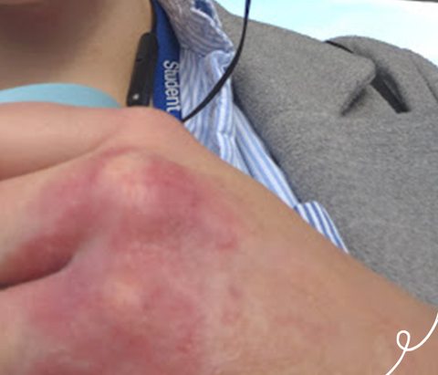 hand with eczema