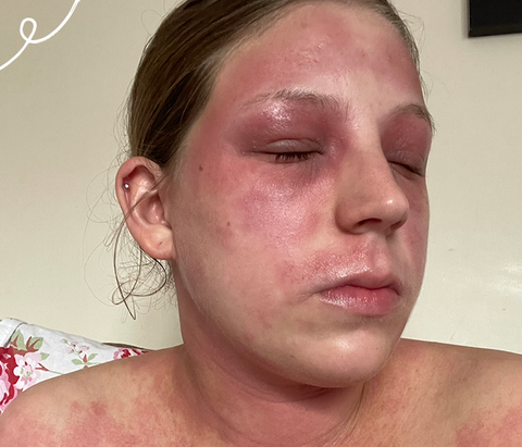 Women with eczema on her face