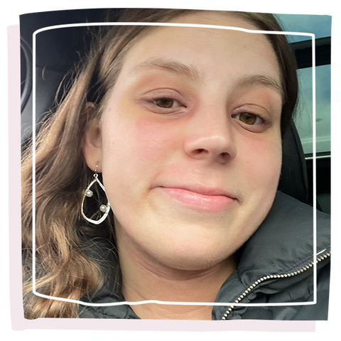 Girl smiling at camera with gold earring and eczema on her face