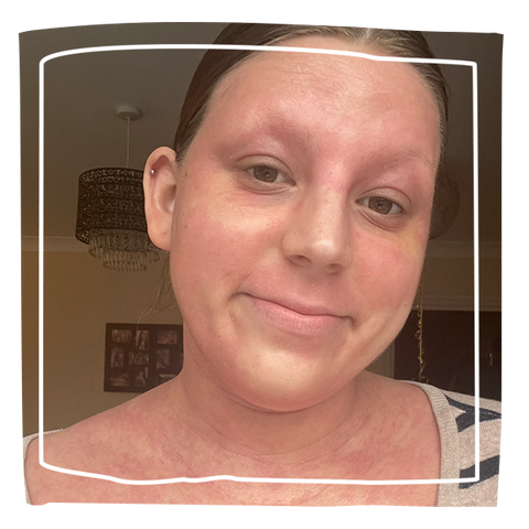 Women smiling into the camera with eczema on her face