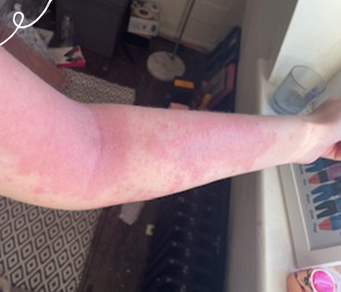 Women's arm with eczema
