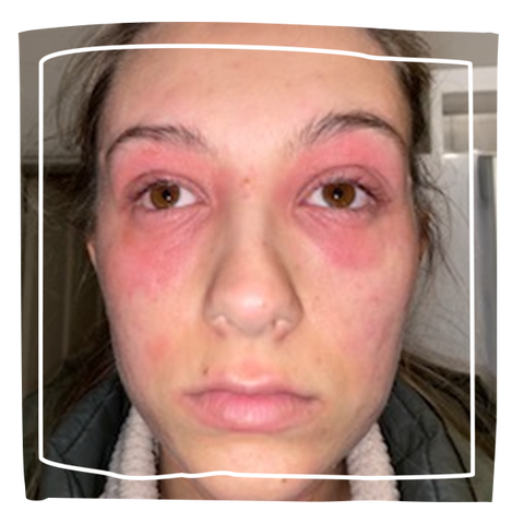 women's face with eczema