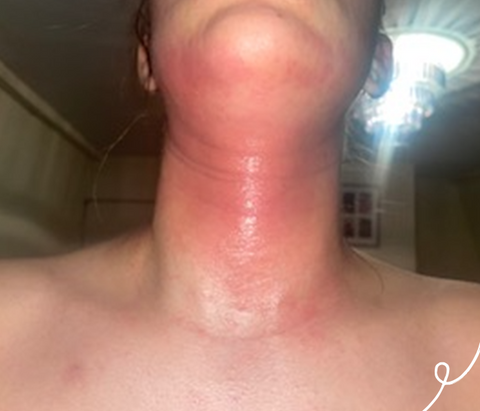 women's neck with eczema