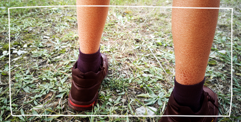 ichthyosis on boys legs