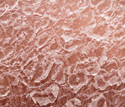 ichthyosis skin close up