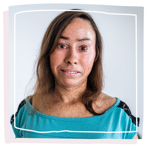 Women with ichthyosis