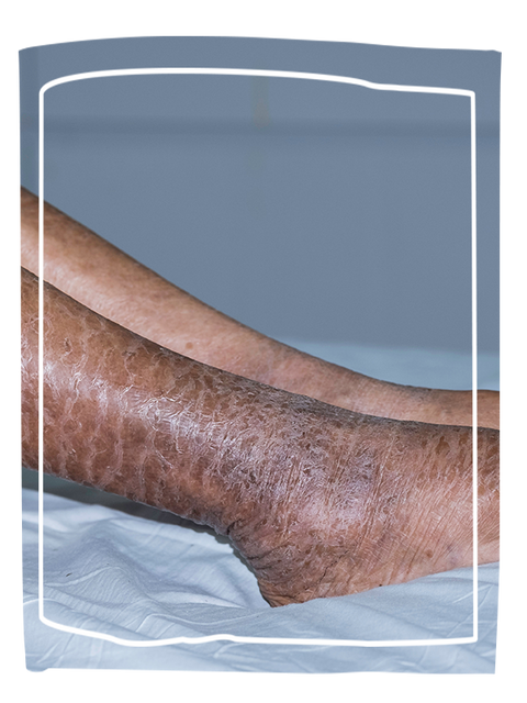 Women with ichthyosis on her legs