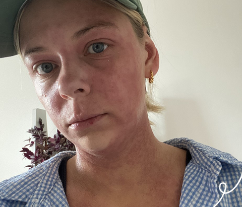 Women wearing a baseball cap with eczema