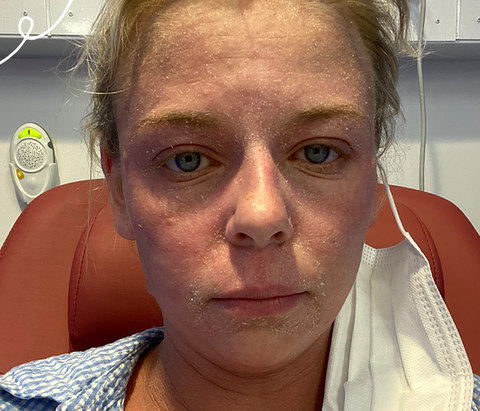 Women in hospital with eczema on her face