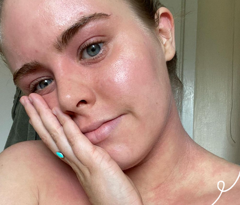 Girl with eczema on face