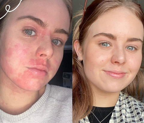Two pictures of the same girl, one with eczema flare up, other without