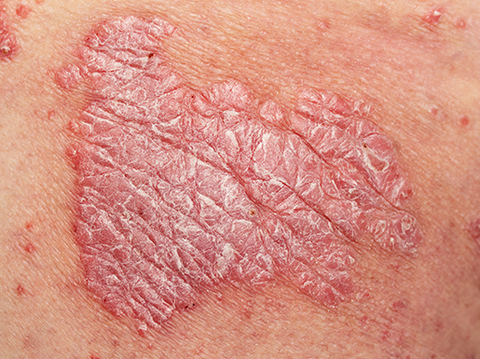 Psoriasis