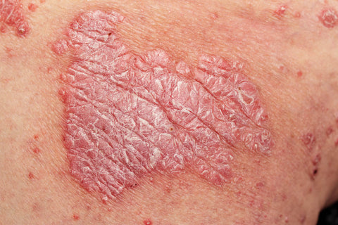 Psoriasis