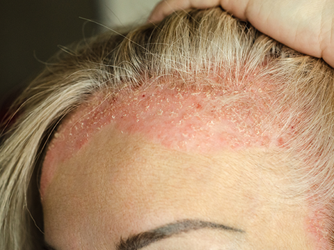 Women with dry skin condition on scalp and hairline