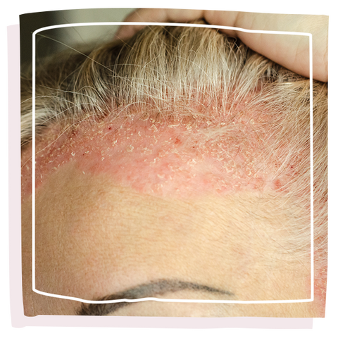 Women with dry skin condition on scalp and hairline