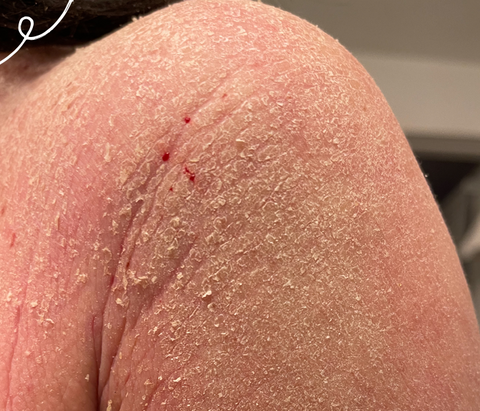 Topical steroid withdrawal on arm