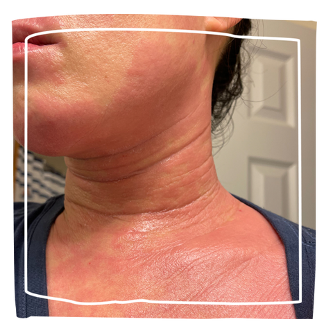 Topical steroid withdrawal on neck