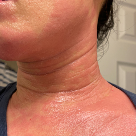 Steoid Rash Topical Steroid Withdrawal – Epaderm