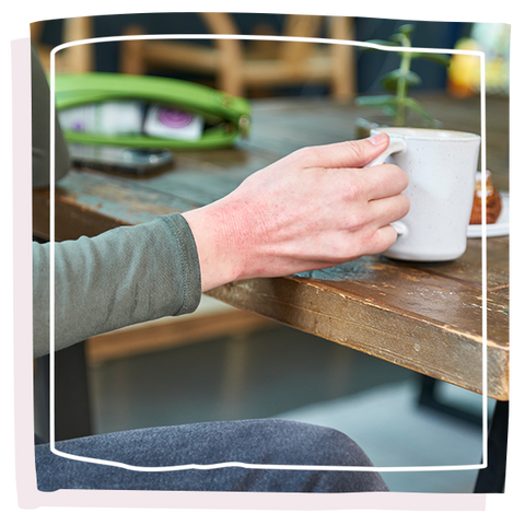 Women hand showing Eczema flare