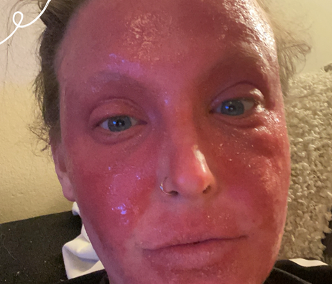 Women with topical steroid withdrawal on her face