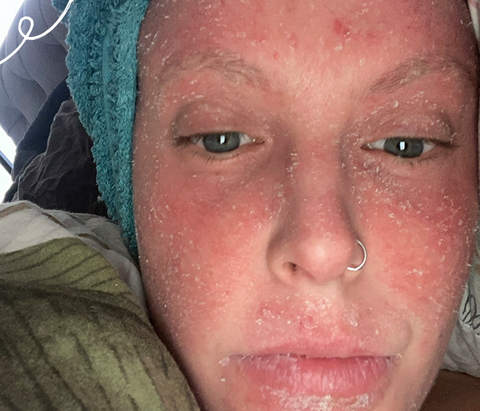 Women with Topical Steroid withdrawal and eczema on her face wearing a towel on her head