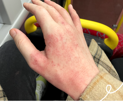 women's hand with eczema on it