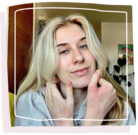 women taking a selfie with eczema on hands