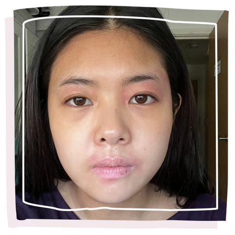 Women with eczema on her face