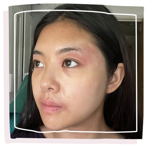 Women with eczema on her face