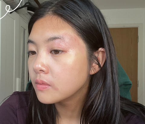 Women with eczema on her face